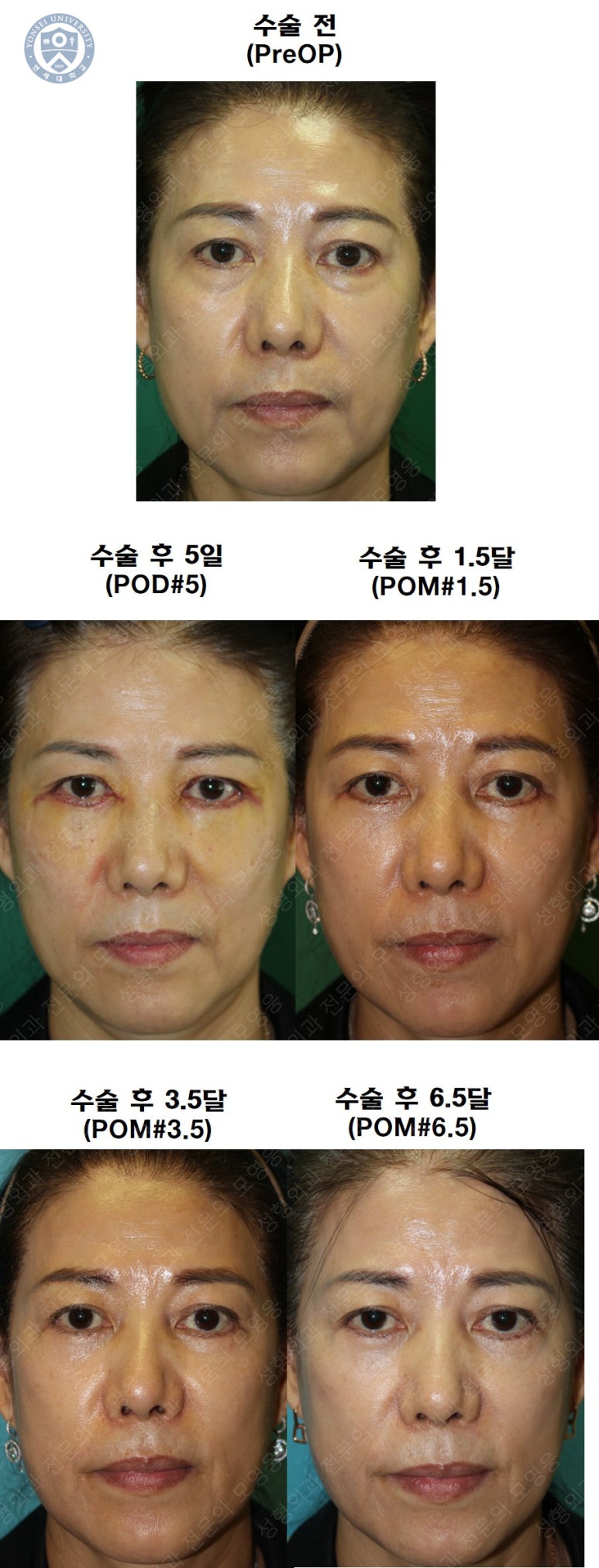 59세 여성, 그레이브스 안병증이 있는 돌출눈 중년 여성 하안검 성형술 (Lower blepharoplasty in Graves 관련 이미지 43