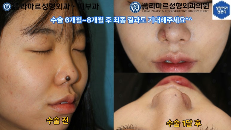 지름 1cm 코 점 제거수술 : 나선피판술(Spiral Flap) 수술전~1달 경과. (Feat. 턱끝필러+사각턱 보톡스) 관련 이미지 14