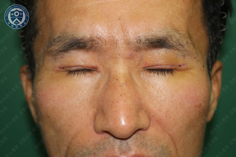 남자눈성형: 무쌍눈매교정 (Blephroptosis correction-levator aponeurosis advancement) 관련 이미지 24