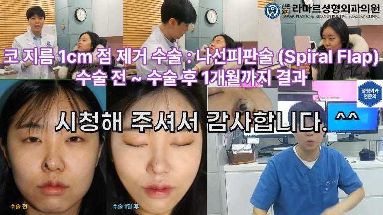 지름 1cm 코 점 제거수술 : 나선피판술(Spiral Flap) 수술전~1달 경과. (Feat. 턱끝필러+사각턱 보톡스) 관련 이미지 190