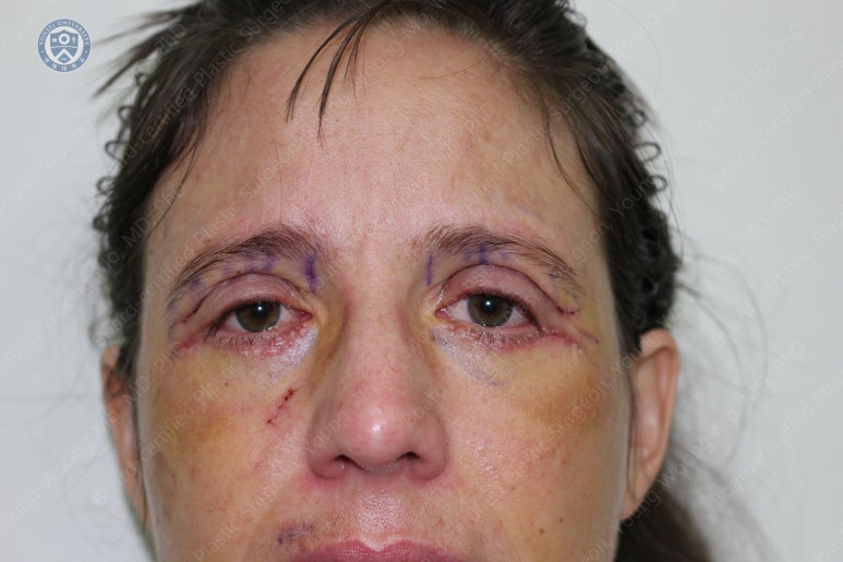 38세 서양 백인 여성, 쌍꺼풀 수술과 눈매교정 및 하안검성형술 (38/F Upper&lower blepharoplasty with levator plication) 관련 이미지 13