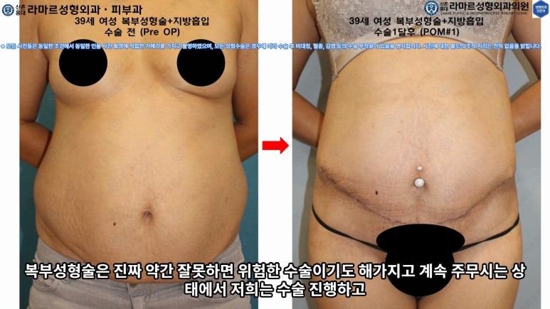 '복부성형술+지방흡입(Abdominoplasty+PAL)' 으로 뱃살 끝장내기! 관련 이미지 60