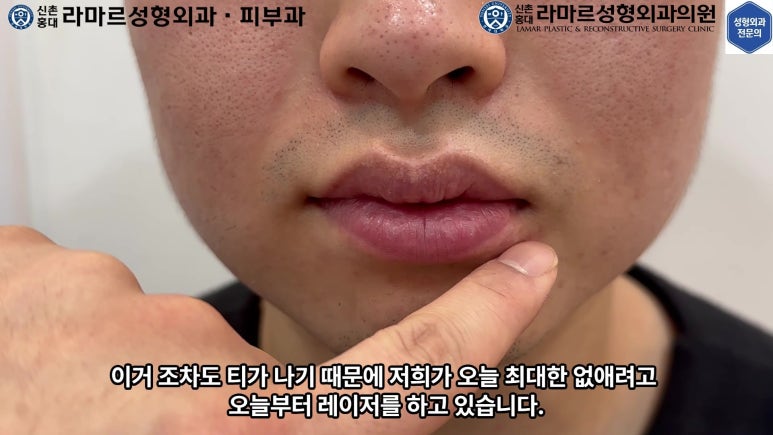 개에 물려 입술 1/3이 뜯긴 19세 남자분 치료 및 흉터 성형수술& 레이저 후기....! 관련 이미지 49