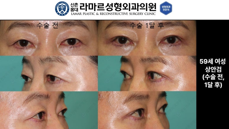 40대~80대 눈 수술 케이스 : 상안검성형술 전후 사진 모음 관련 이미지 23
