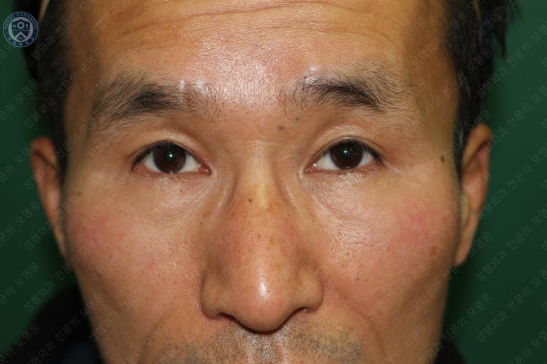 남자눈성형: 무쌍눈매교정 (Blephroptosis correction-levator aponeurosis advancement) 관련 이미지 38