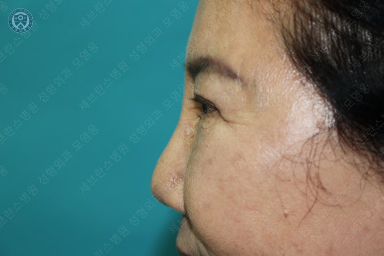 71세 여성, 이마거상술과 이마축소술 (71/F, Forehead lift and reduction) 관련 이미지 44