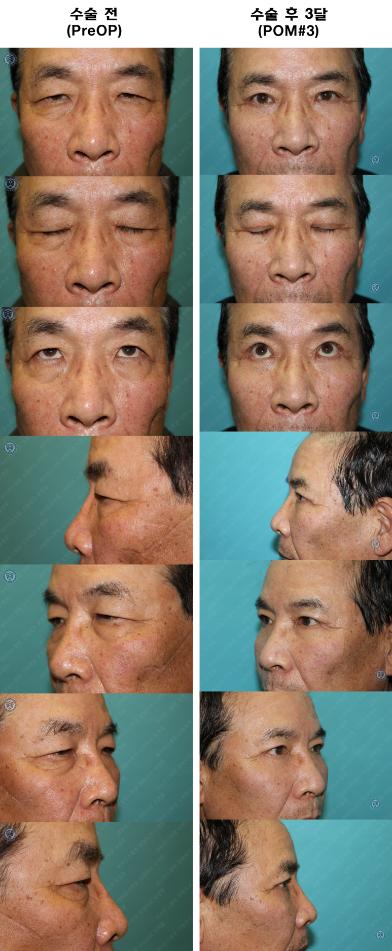 67세 남성, 상&middot;하안검성형술 및 안검하수교정 (67/M, Upper &  lower blepharoplasty with ptosis correction) 관련 이미지 46