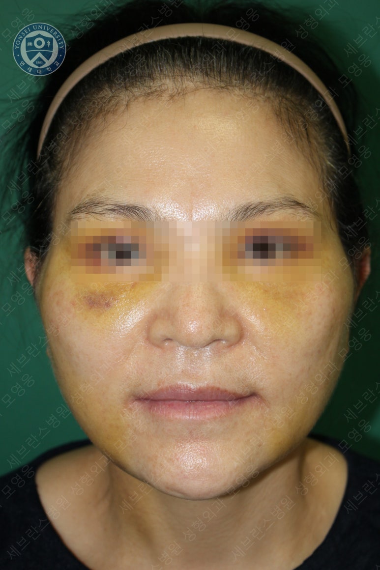 55세 여성, 이중평면 안면거상(55/F, Dual-plane full facelift) 관련 이미지 24