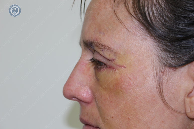 38세 서양 백인 여성, 쌍꺼풀 수술과 눈매교정 및 하안검성형술 (38/F Upper&lower blepharoplasty with levator plication) 관련 이미지 16