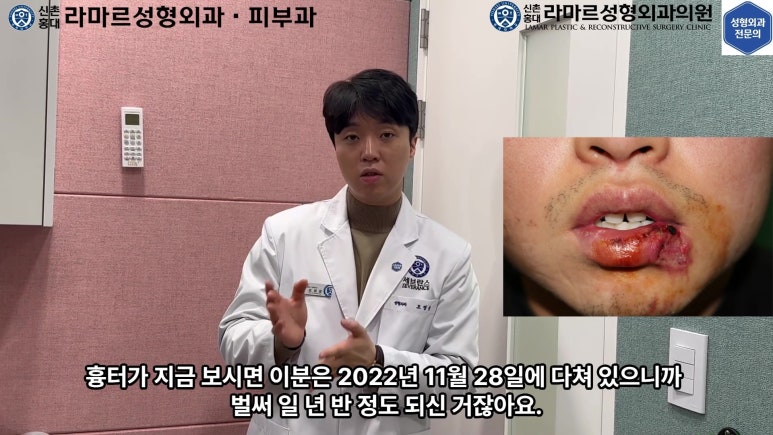 개에 물려 입술 1/3이 뜯긴 19세 남자분 치료 및 흉터 성형수술& 레이저 후기....! 관련 이미지 95