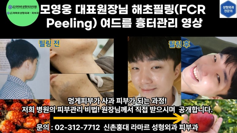 모영웅 대표원장 해초필링(FCR peeling) 피부관리영상...! 멍게피부가 사과피부가 되는 과정을 보여드립니다^^ 관련 이미지 16