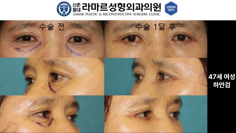30대~80대 눈 수술 케이스 : 하안검성형술 전후 사진 모음 관련 이미지 16