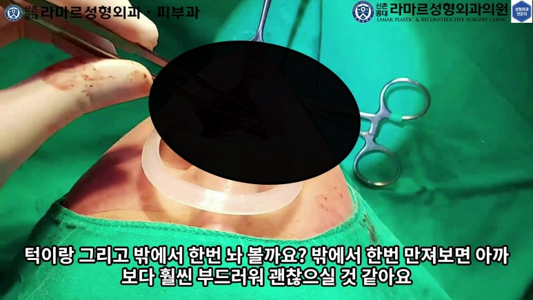 파라핀 필러 입 안 절개로 흉터없이 빼내기! 관련 이미지 77