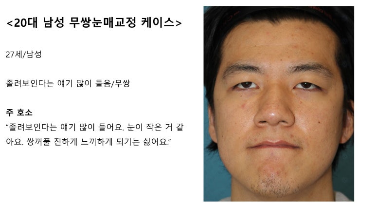 27세 남성 무쌍(속쌍)눈매교정 (27/M Ptosis correction with double lid plasty) 관련 이미지 2