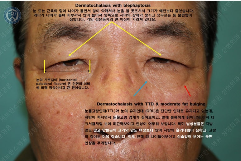 67세 남성, 상&middot;하안검성형술 및 안검하수교정 (67/M, Upper &  lower blepharoplasty with ptosis correction) 관련 이미지 17