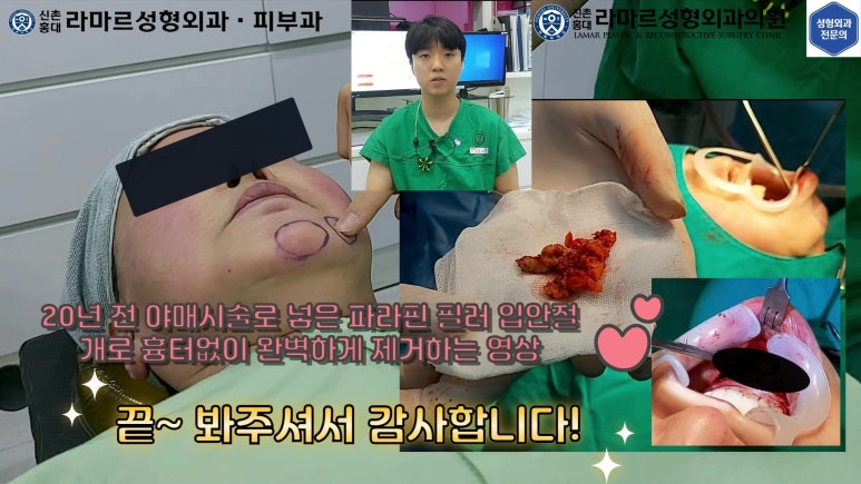 파라핀 필러 입 안 절개로 흉터없이 빼내기! 관련 이미지 118