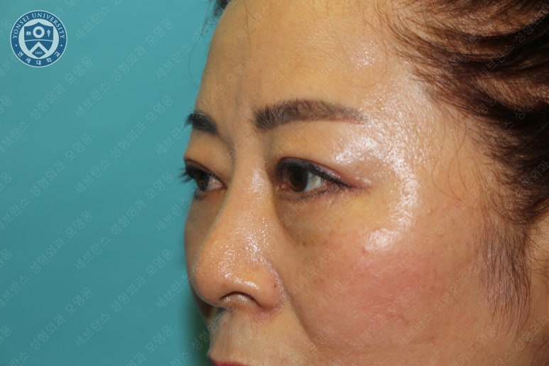 60세 여성, 상안검 및 하안검 성형술 증례 (60/F Upper & lower blepharoplasty) 관련 이미지 27