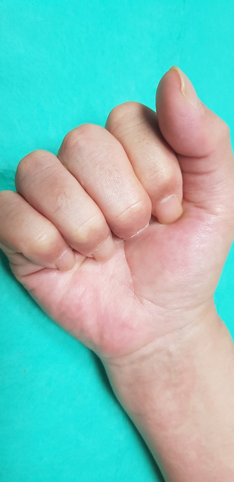 수지 말단부 절단에 시행한 동측 역행성 유경피판술 증례 (Homodigital Reverse Island Flap for Fingertip Amputation) 관련 이미지 15