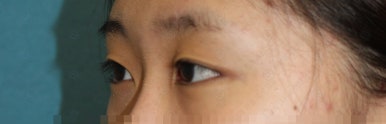 17세 여성, 쌍꺼풀+앞트임(DEO+Medial epicanthoplasty) 관련 이미지 6