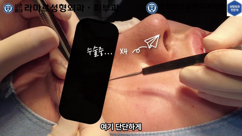 29세 남자, 소시지 쌍꺼풀 두줄따기로 낮추기 (쌍꺼풀 재수술) 관련 이미지 30