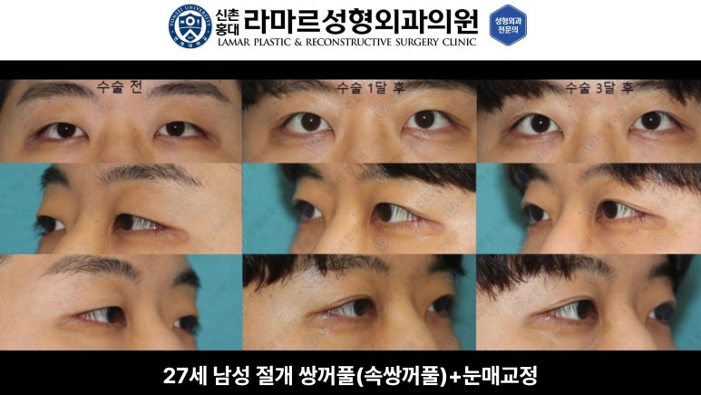 10대~30대 눈 수술 케이스 : 대표원장님 쌍꺼풀 전후 사진 모음 관련 이미지 9