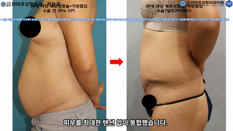 '복부성형술+지방흡입(Abdominoplasty+PAL)' 으로 뱃살 끝장내기! 관련 이미지 56