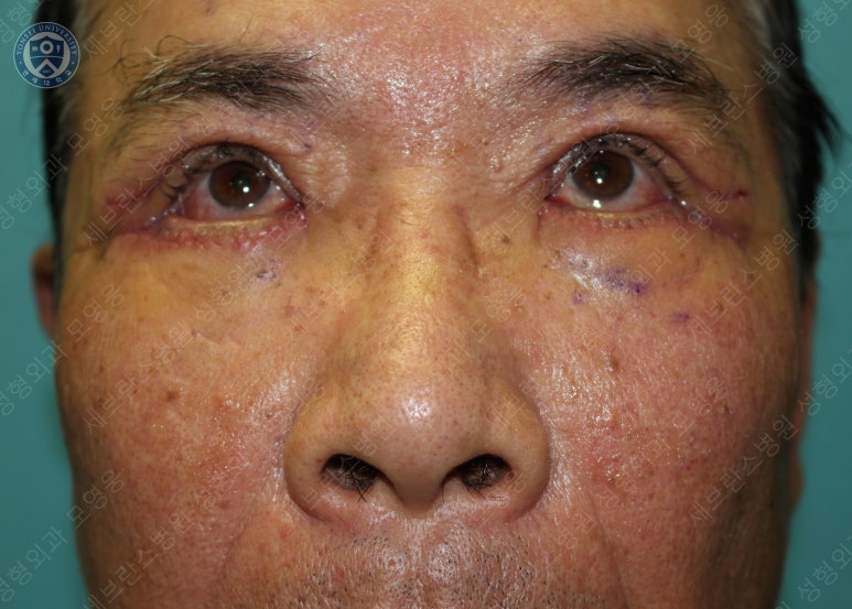 67세 남성, 상&middot;하안검성형술 및 안검하수교정 (67/M, Upper &  lower blepharoplasty with ptosis correction) 관련 이미지 23