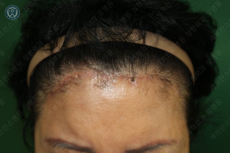 71세 여성, 이마거상술과 이마축소술 (71/F, Forehead lift and reduction) 관련 이미지 37