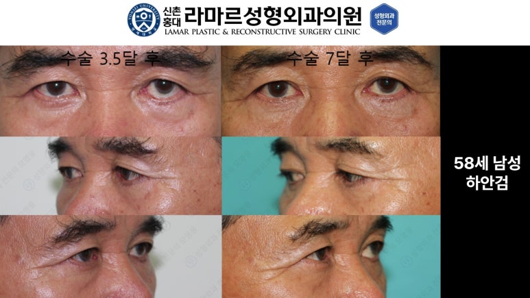30대~80대 눈 수술 케이스 : 하안검성형술 전후 사진 모음 관련 이미지 44