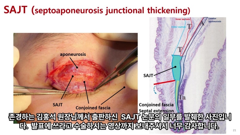 이대역 성형외과 개원의 퇴근 후 V-log 제 8편 : 눈성형연구회 학술심포지엄 발표 (눈성형연구회 학술위원) 관련 이미지 60