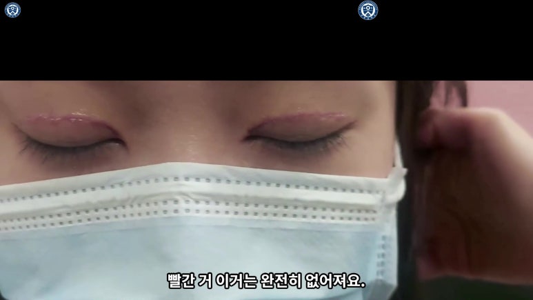 매몰 쌍꺼풀 풀고 절개쌍꺼풀로 바꾸는 쌍꺼풀 재수술!! 관련 이미지 69