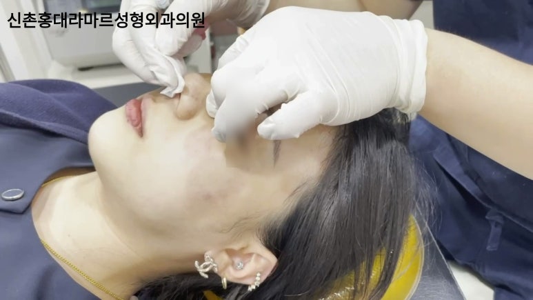 20대 여성 코필러 시술 영상 관련 이미지 7