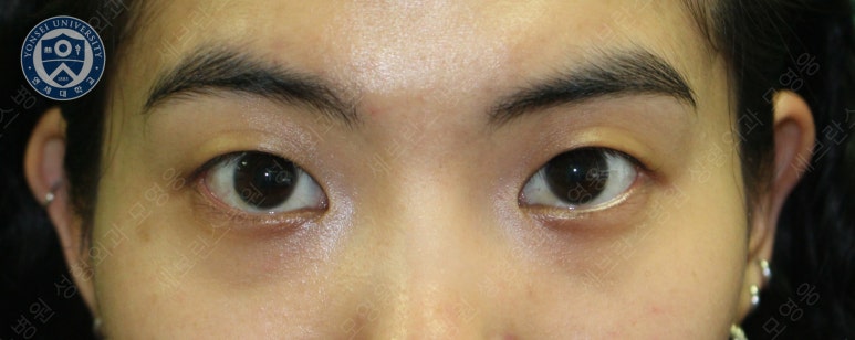 28세 여성, 눈밑지방재배치(눈밑지, 28/F Transconjunctival septal fat redraping-internal fixation technique) 관련 이미지 3