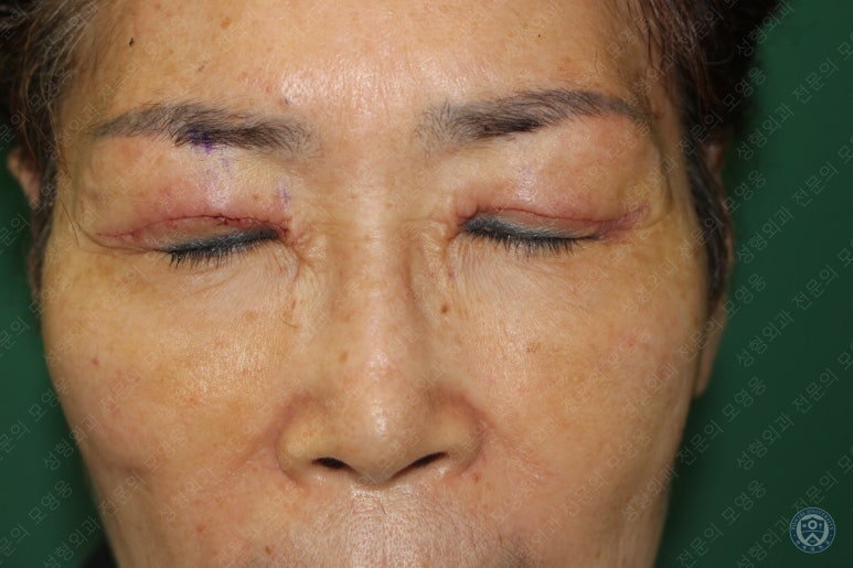 64세 여성 상안검성형술+눈매교정 (64/F Upper blepharoplasty with ptosis correction) 관련 이미지 12
