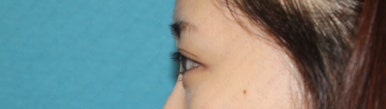 17세 여성, 쌍꺼풀+앞트임(DEO+Medial epicanthoplasty) 관련 이미지 26