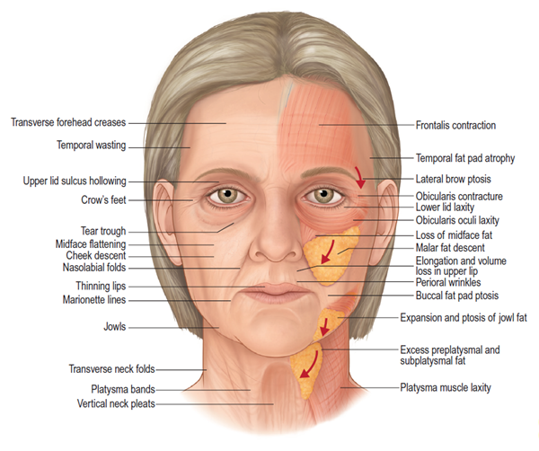 55세 여성, 이중평면 안면거상(55/F, Dual-plane full facelift) 관련 이미지 13