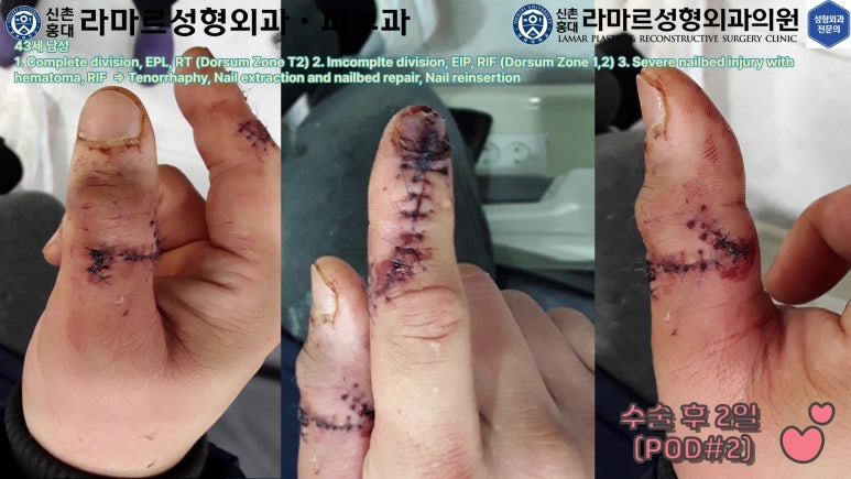 손가락 힘줄 손상 및 열상, 손톱 바닥 열상 처치 (Extensor tendon repair and nailbed injury treatment) 관련 이미지 38