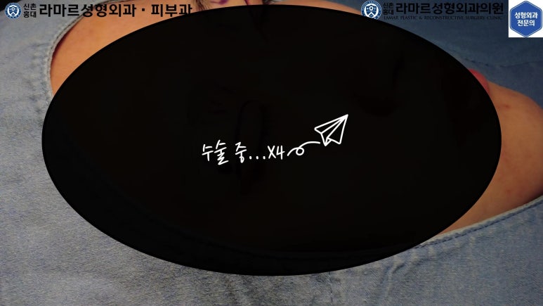 매몰 쌍꺼풀 풀고 절개쌍꺼풀로 바꾸는 쌍꺼풀 재수술!! 관련 이미지 20