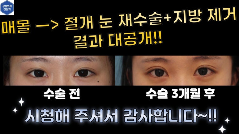 매몰 쌍꺼풀 풀고 절개쌍꺼풀로 바꾸는 쌍꺼풀 재수술!! 관련 이미지 85
