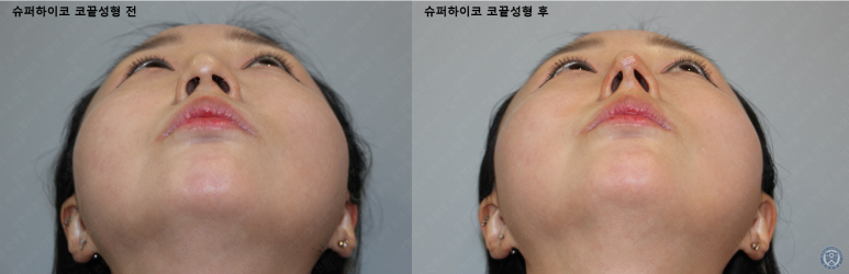 31세 여성 최소침습 하이코 코끝성형 관련 이미지 11