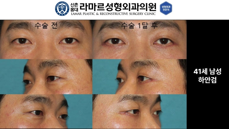 30대~80대 눈 수술 케이스 : 하안검성형술 전후 사진 모음 관련 이미지 18