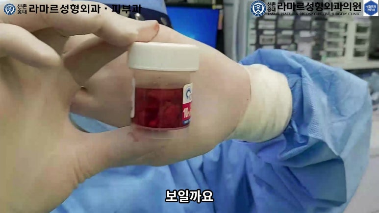파라핀 필러 입 안 절개로 흉터없이 빼내기! 관련 이미지 87