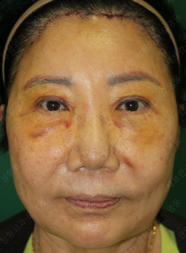 71세 여성, 이마거상술과 이마축소술 (71/F, Forehead lift and reduction) 관련 이미지 20