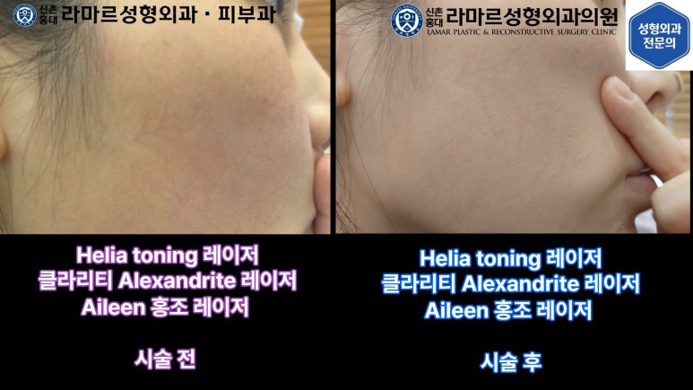 우리병원 토닝레이저 실제 시술과정 보여드립니다. 관련 이미지 37