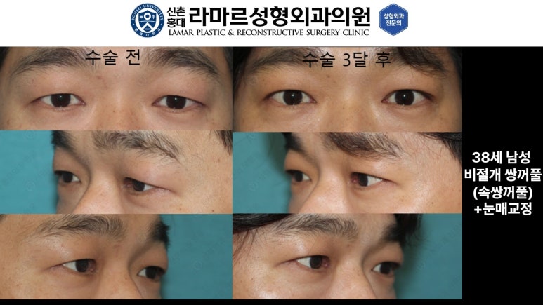 10대~30대 눈 수술 케이스 : 대표원장님 쌍꺼풀 전후 사진 모음 관련 이미지 19