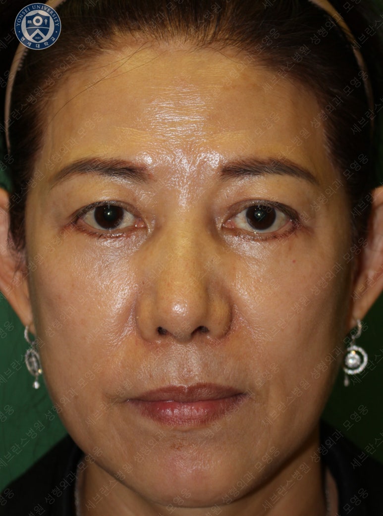 59세 여성, 그레이브스 안병증이 있는 돌출눈 중년 여성 하안검 성형술 (Lower blepharoplasty in Graves 관련 이미지 17