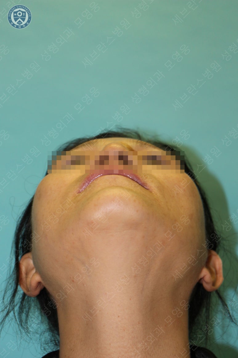 55세 여성, 이중평면 안면거상(55/F, Dual-plane full facelift) 관련 이미지 11