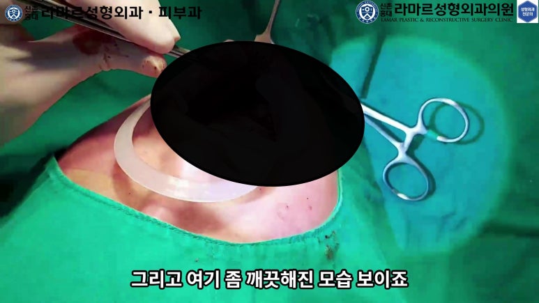 파라핀 필러 입 안 절개로 흉터없이 빼내기! 관련 이미지 76