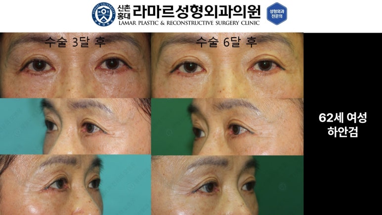 30대~80대 눈 수술 케이스 : 하안검성형술 전후 사진 모음 관련 이미지 41