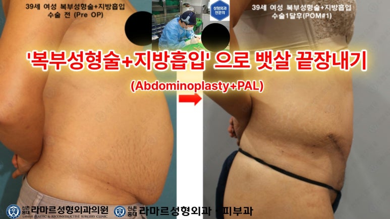 '복부성형술+지방흡입(Abdominoplasty+PAL)' 으로 뱃살 끝장내기! 관련 이미지 7